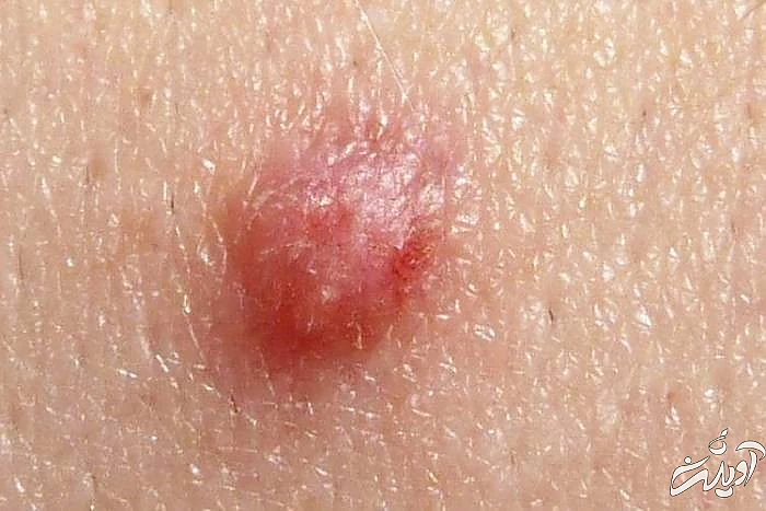 زگیل تناسلی